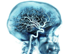        .       20-25%   ,      20%    .         50% (   alz.org). 